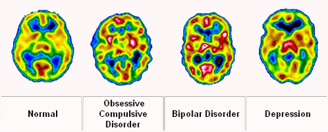 Brain activity patterns of different mental disorders Brain activity patterns of different mental disorders